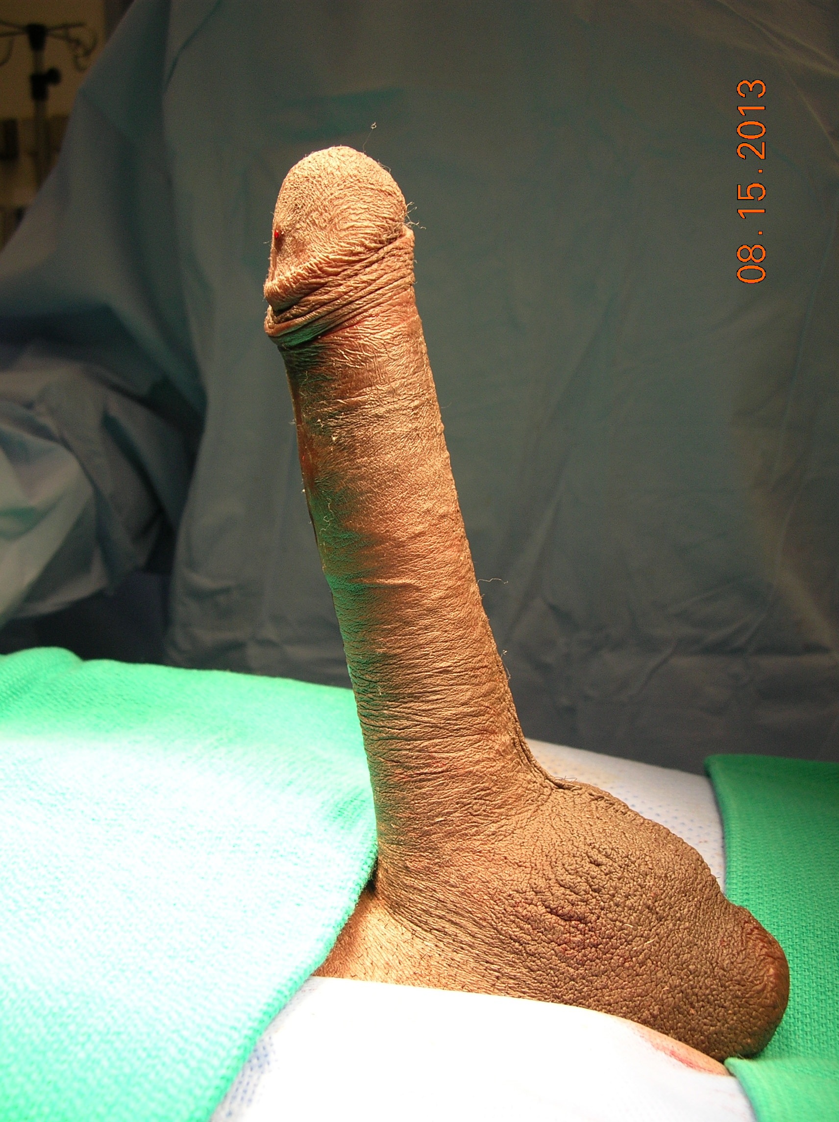 Maximum Penile Length & Girth by Dr. Garber